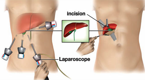 MIS-General-Surgery-Laparoscopic-cholecystectomy